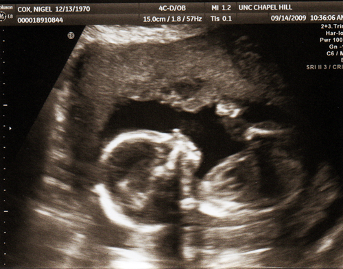 Ultrasound